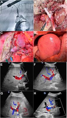Application Effectiveness of Segment IV Portal Vein Reconstruction for Early Postoperative Liver Function Recovery in Split Liver Transplantation